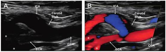 正確的電源穩壓器能最大限度地減少直流電軌噪聲并提高超聲圖像的質量 正確的電源穩壓器能最大限度地減少直流電軌噪聲并提高超聲圖像的質量